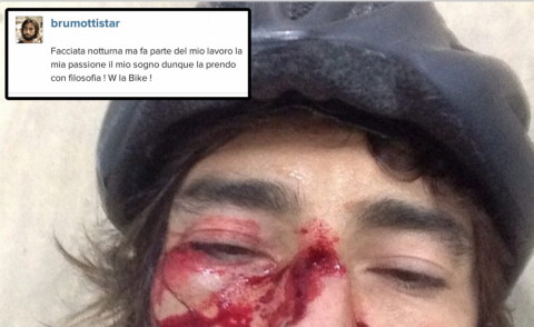 Vittorio Brumotti - Pietra Ligure - 15-07-2014 - Vittorio Brumotti: ecco la maschera di sangue dopo l'incidente