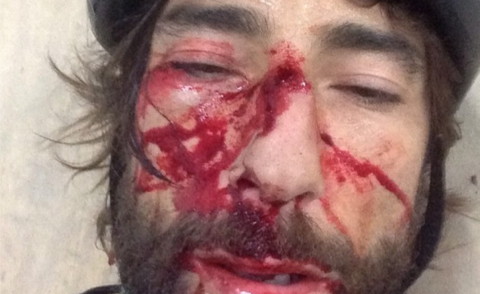 Vittorio Brumotti - Pietra Ligure - 15-07-2014 - Vittorio Brumotti e il padre aggrediti a calci e pugni